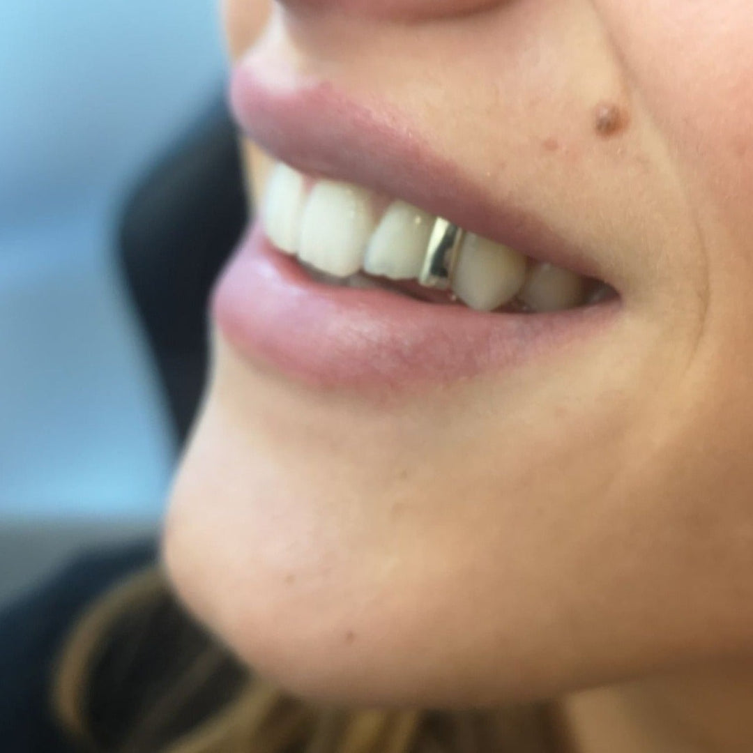 Gap filler, Gold Strip Design