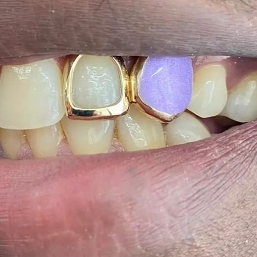 Enamel (Opal effect) cap *Any colour* and Window set